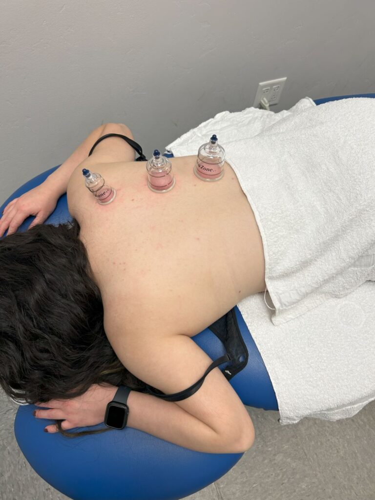 cupping on a woman's back